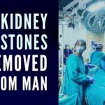The stones were fully extracted after a procedure that lasted for three hours